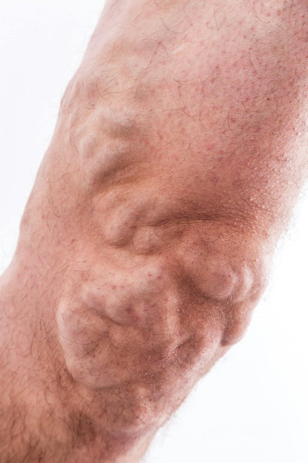 Réduire la rétention d'eau : conseils pour réussir